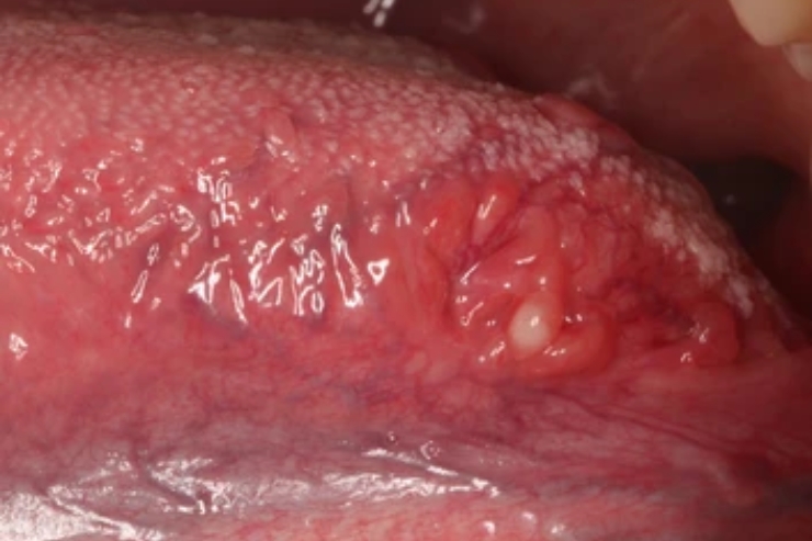 Base of tongue and tonsillar tumor resection