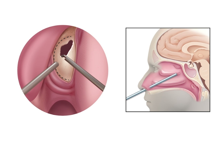 Endoscopic or open resection of anterior skull base and sinonasal tumors