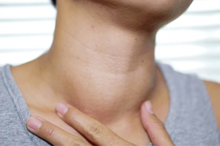 Excision of neck masses (e.g., lymph nodes, branchial cleft cysts, dermoids)