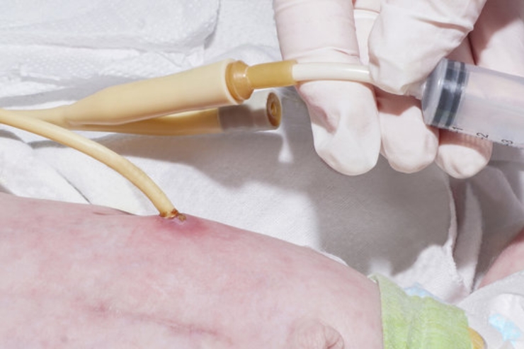 Feeding jejunostomy or PEG tube insertion