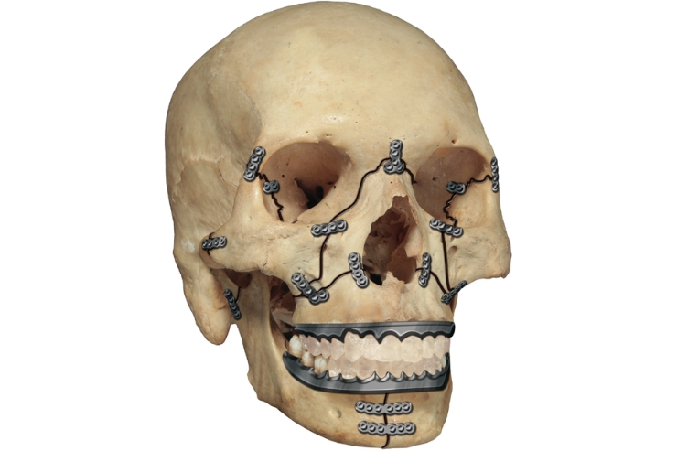 Management of panfacial trauma