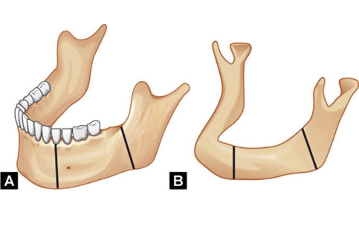 Marginal or segmental mandibulectomy