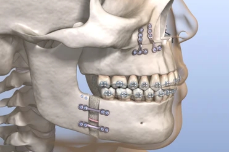 Maxillectomy (partial or total)