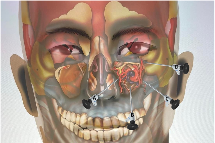 Maxillectomy with orbital exenteration (if needed)