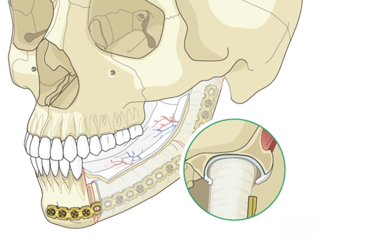 Microvascular free flap reconstructions_ Fibula, Radial forearm (RFFF), Anterolateral thigh (ALT), Scapula