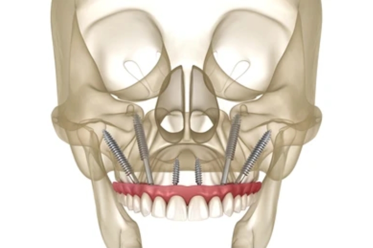 Orbital reconstruction with implants or grafts
