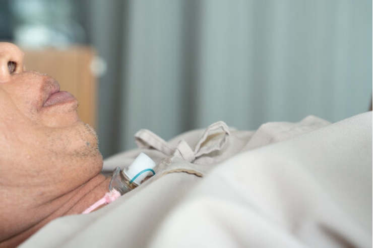 Palliative tracheostomy or pharyngostoma