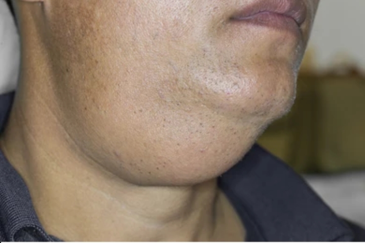 Submandibular gland excision