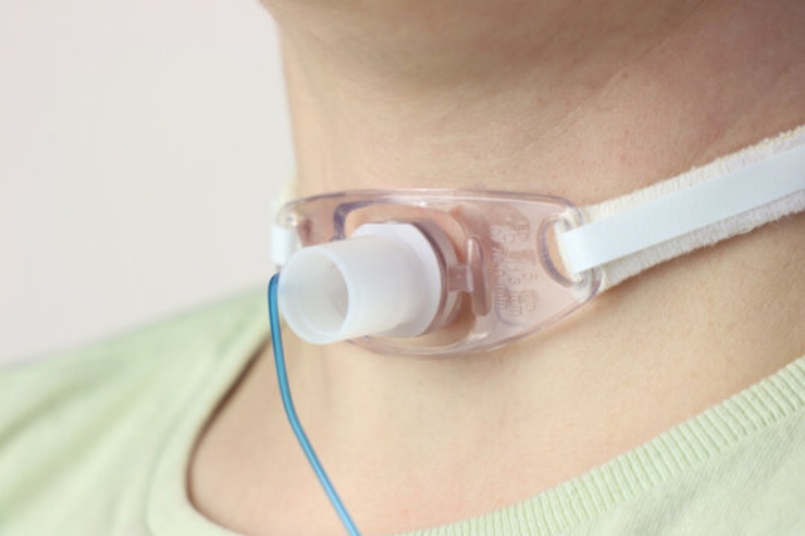 Tracheostomy