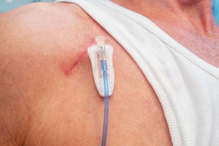 Tumor debulking for palliation