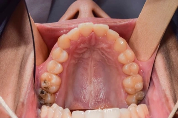 Wide local excision or composite resection of_ Tongue, Floor of mouth, Buccal mucosa, Gingiva, Hard palate
